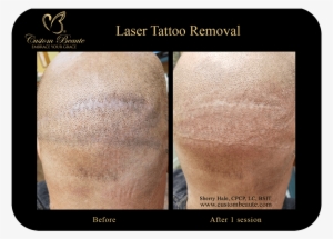 Video Player - Embrace Scar Before And After