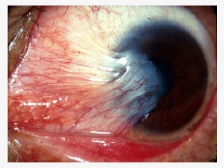 Eyes Pterygium - Ocular Rosacea Eye