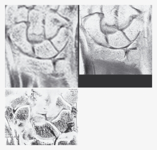 Triangular Fibrocartilage Tear Syndrome - Sketch