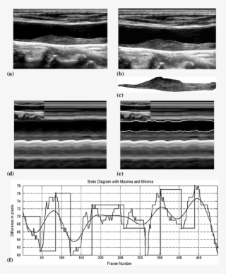Illustration Of The M-mode Procedure - Monochrome