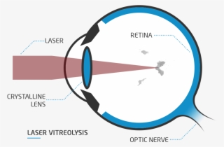 What Is Laser Vitreolysis - Presbiopia Png