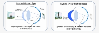Lasik Surgery In Delhi - Eifelturm Grafik