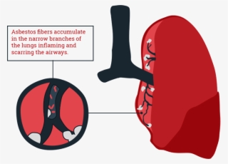Asbestosis And Asbestos Exposure - Asbestosis Png