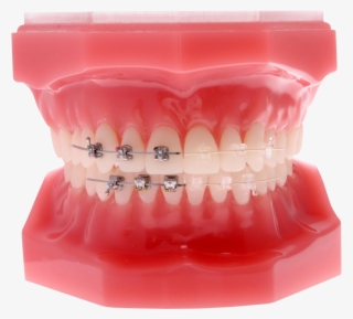 Self-ligating Braces - - Self Ligating Clear Braces