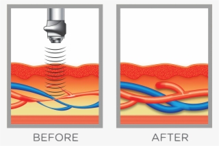 Swiss Wave Therapy Demo11 - Stl Medical Solutions St. Louis' Premier Men's Clinic