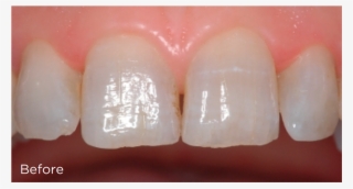Before Veneers - Composite Material