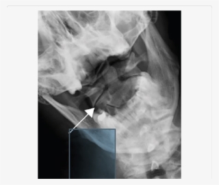 Ap Open Mouth Radiograph Of The C1 C2 Levels Showing - Radiography