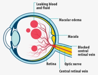 Picture Of Effects Of Mefcrvo On The Eye, Showing Leaking - Macula Of Retina