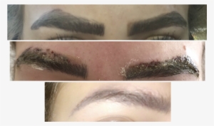Elinimink Eyebrow Correction - Eyebrow Laser Tattoo Removal