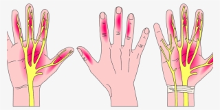 Carpal Tunnel Syndrome Painting