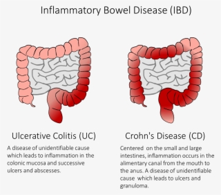 Figure 1) Ibd Is A Group Of Diseases Which Cause Inflammation - Inflammatory Bowel Disease Adalah
