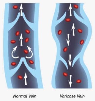 Varicose Veins - Vericose Veins Testical