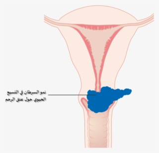 Diagram Showing Stage 2b Cervical Cancer Cruk 216-ar - Cervical Cancer