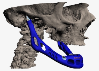 A Lower Jaw Made Of Titanium And Ceramic - Additive Manufacturing In Medical Implants