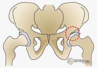 [ ] Enlarge - Hip Dysplasia Torn Labrum