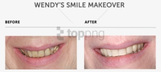 Free Png Download Teeth Makeover Png Images Background - Teeth Makeover