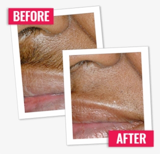 I'm Incredibly Pleased With This Product I Have Two - Beard Removal Cream For Face