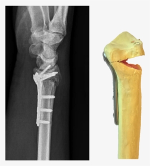 Lateral X-ray Of A Distal Radius Fracture Treated With - Wrist Plate And Screws