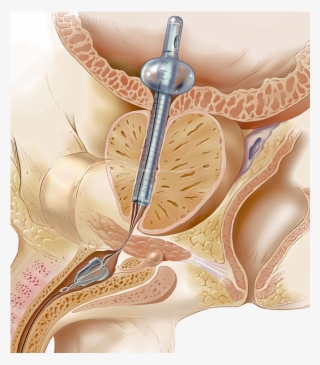 Greatly Preferred By Patients Over Catheterization - Catheter Alternative