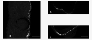 3-d Presentation Of A Laser Ablation Cavity (vsp, 28 - Radiology