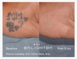 Tattoo Removal* - Tattoo