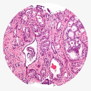 Tissue Cancer