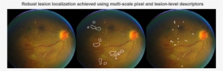Deep Learning In Ophthalmology How Google Did It - Earth