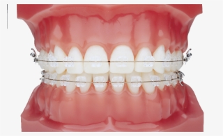 Ceramic Braces - Imágenes De Frenos Dentales