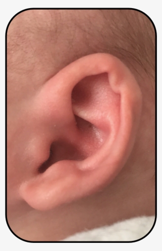 Corrected Baby Ear Usa Parent Story