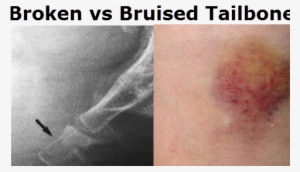 Bruised Tailbone Vs Broken Tailbone - Bruised Tailbone