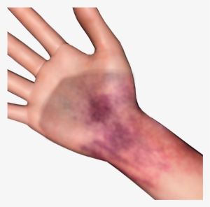 Bruise Photosymbols - Human Leg