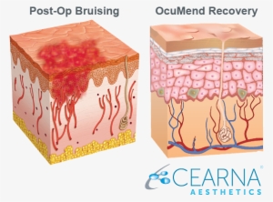 The Only Patented Bruising And Swelling Solution Backed - Skin