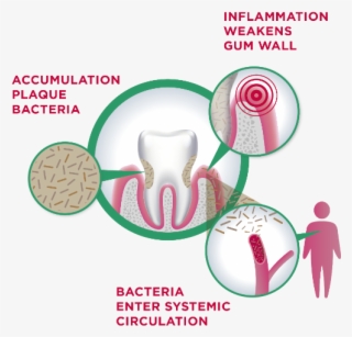 The Gum Link - Diagram