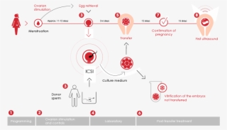 Gráfico De Fases De Fiv-icsi Con Semen De Donante - Fécondation In Vitro Icsi