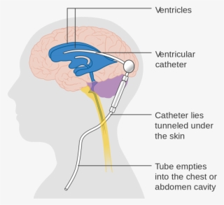 Diagram Showing A Brain Shunt Cruk - Program Valve Shunt