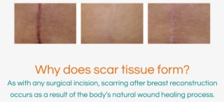 Why Does Scar Tissue Form - Incision Scar Healing Process