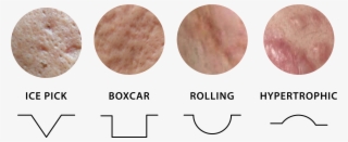 Airjet Acne Scar Treatment Shiro Aesthetic Cinic - Mettwurst