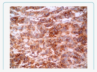 Cd 56 Stain Show Diffuse Strong Cytoplasmic Staining - Dessert