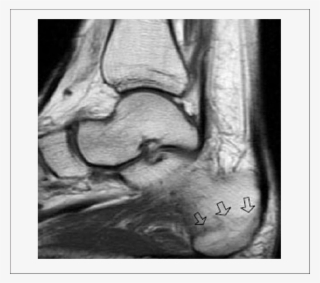 Radiograph Before Shock Wave Therapy - X-ray