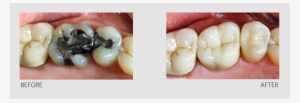 Most Often Complete Your Crown In One Visit With A - Filling Removal
