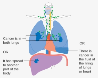 Tnm Staging Lung Cancer