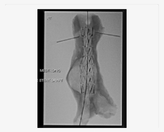 Preoperative Simulation Of Evar On An Aaa Shell - Rib