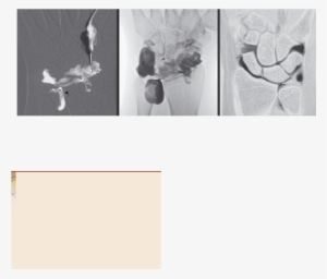 Triangular Fibrocartilage Tear Syndrome - Visual Arts